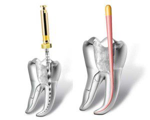 Tratament Endodontie