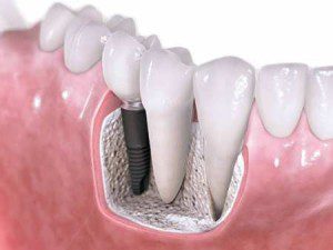 Implant dentar